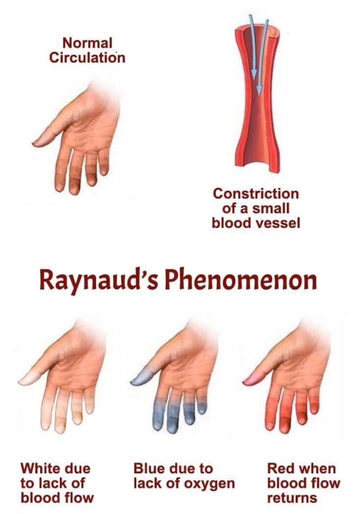 Cold Hands: Winter Weather or Raynaud's Phenomenon or Disease?